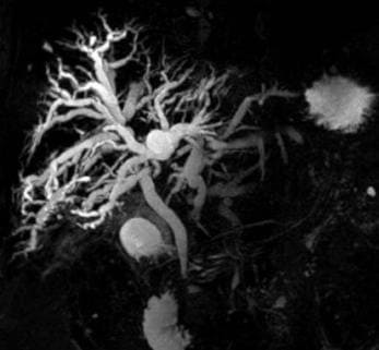 снимок МР-холангиографии желчевыводящих протоков